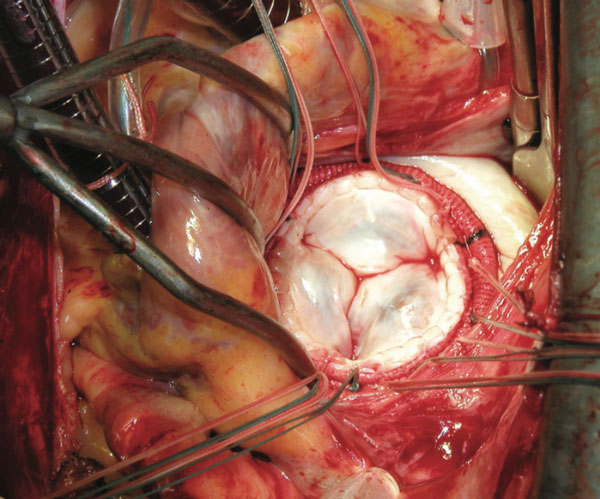 Hình ảnh phẫu thuật van tim