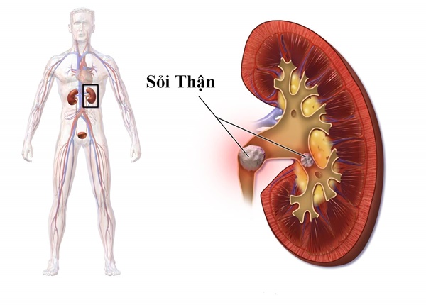 Một số nguyên nhân và triệu chứng suy thận cấp