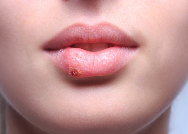 Dấu hiệu nhận biết bệnh Herpes sinh dục và cách phòng tránh