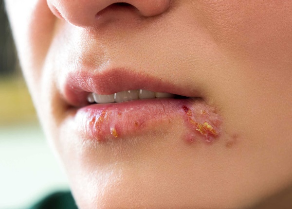 Những điều bạn cần biết về Herpes sinh dục (HSV)