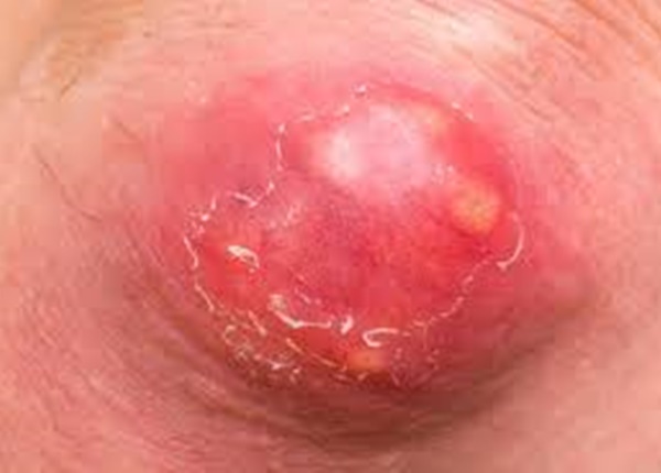 Khi điều trị nhọt, bạn cần chú ý điều gì?