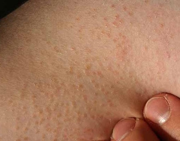 viêm nang lông có thể diễn biến thành áp-xe