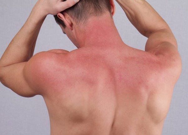 Phân loại bỏng theo diện tích vết bỏng