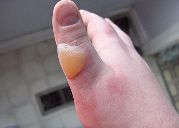 Phân loại theo độ sâu của vết bỏng