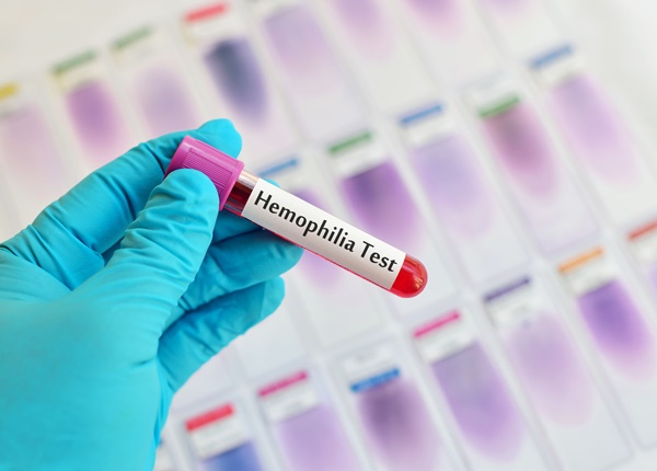 Bệnh Hemophilla có thể chữa khỏi không?