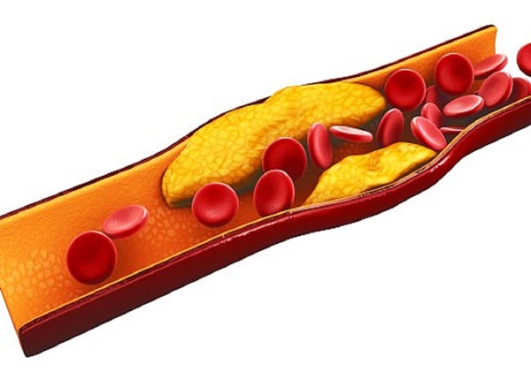 Điều trị xơ vữa động mạch
